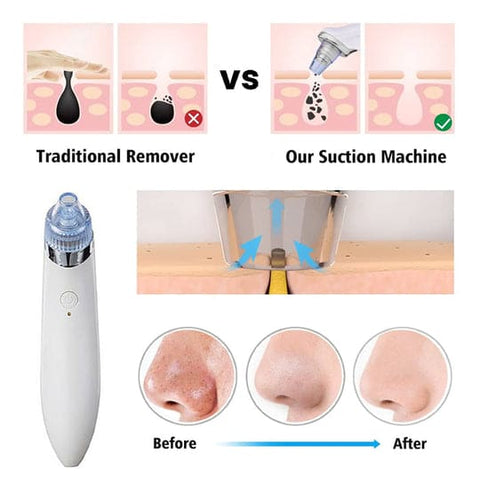4 in 1 Blackhead Removal Machine - Areebreviews
