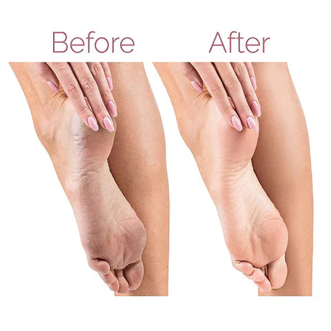 Electric Pedicure Foot File Callus Remover - Areebreviews